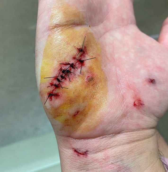 Palm with stitched wound and bruising
